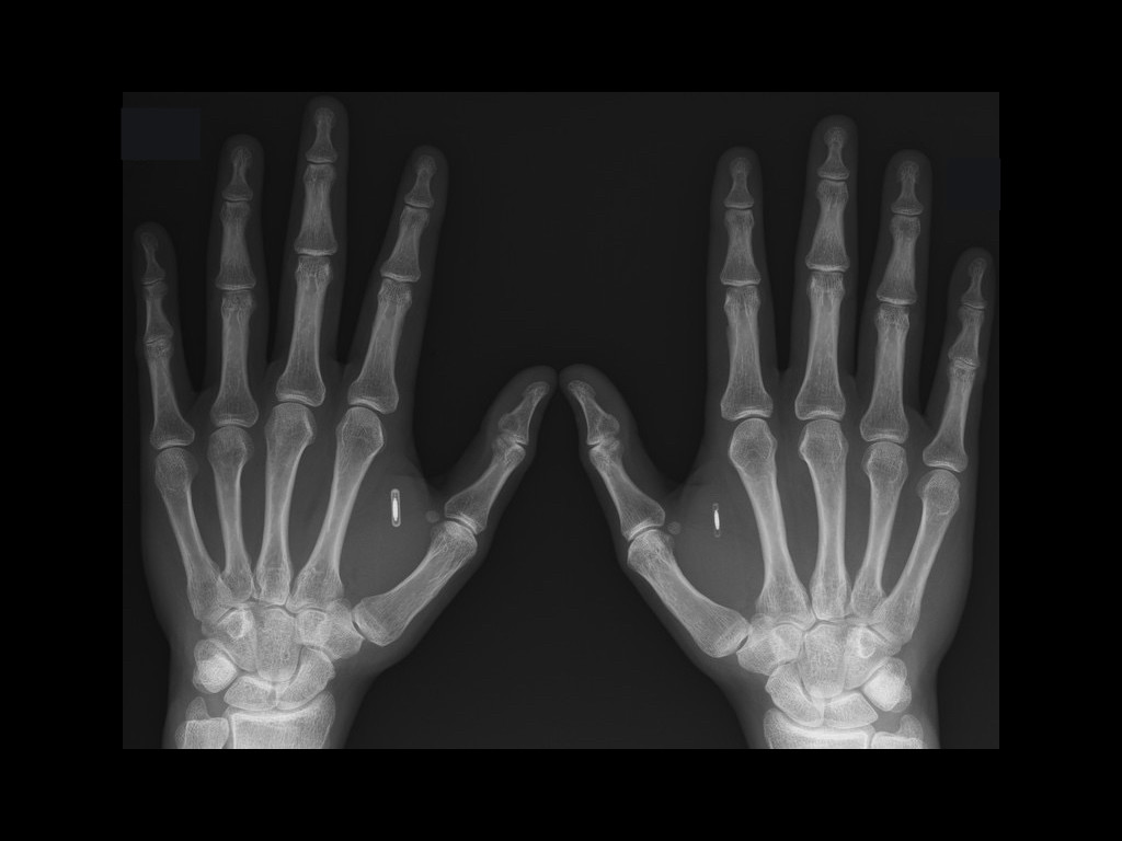 IMPLANT 1.001